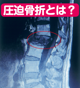 クシャミだけで骨折！？脊柱管狭窄症と密接に関係する圧迫骨折に要注意